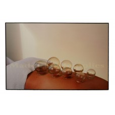 35117 Cupping Therapy
